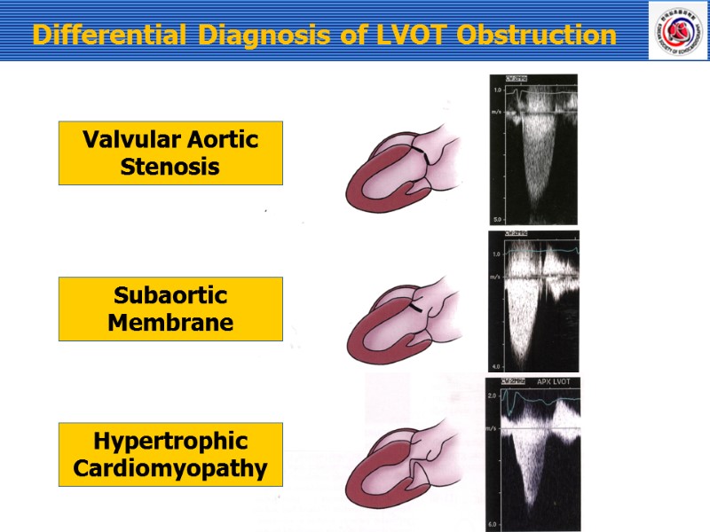 Differential Diagnosis of LVOT Obstruction   Valvular Aortic  Stenosis Subaortic  Membrane